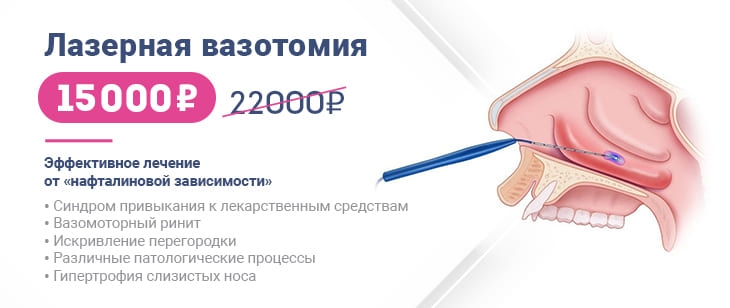 Лазерная Вазотомия